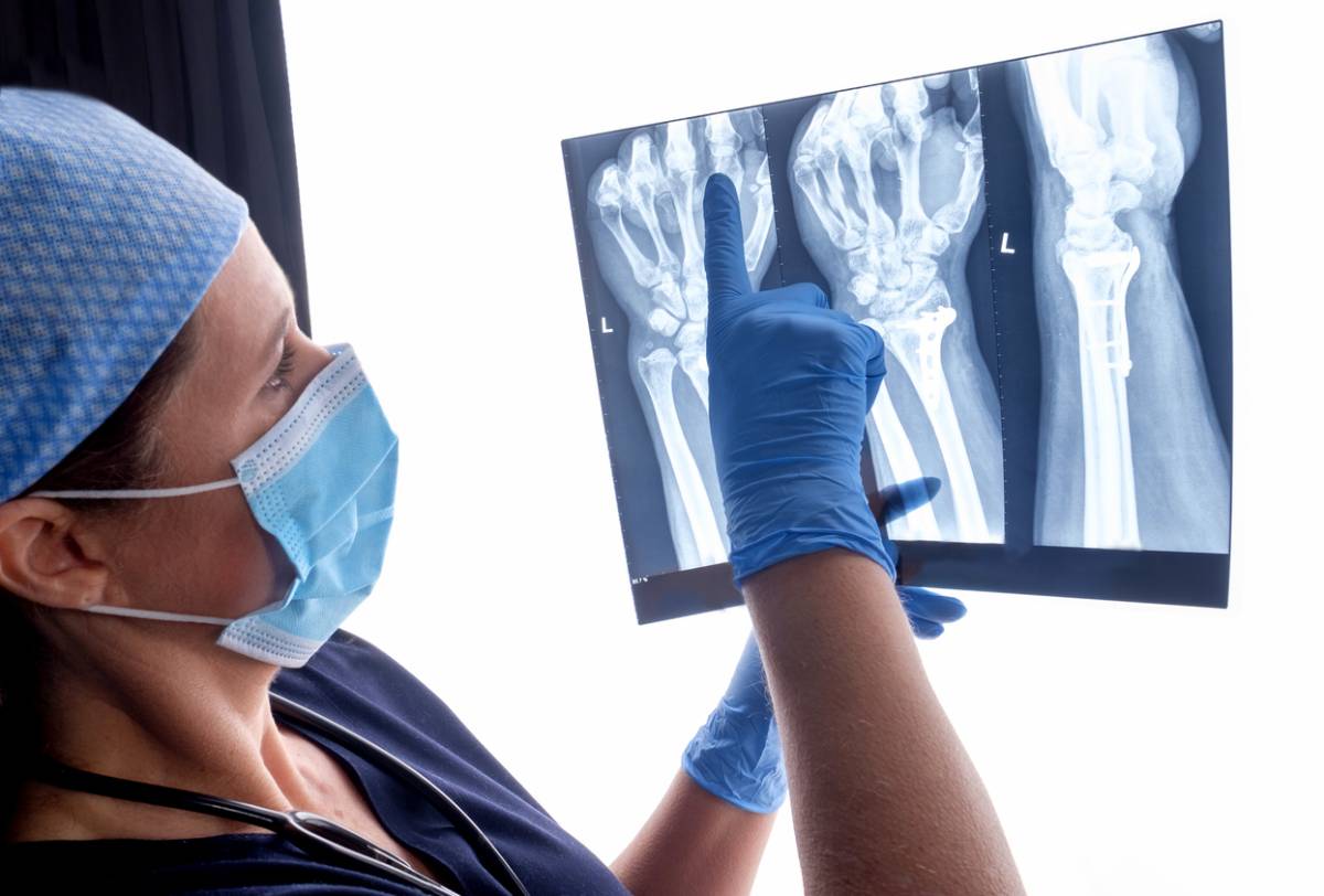 Need for Surgery in Bone Fractures