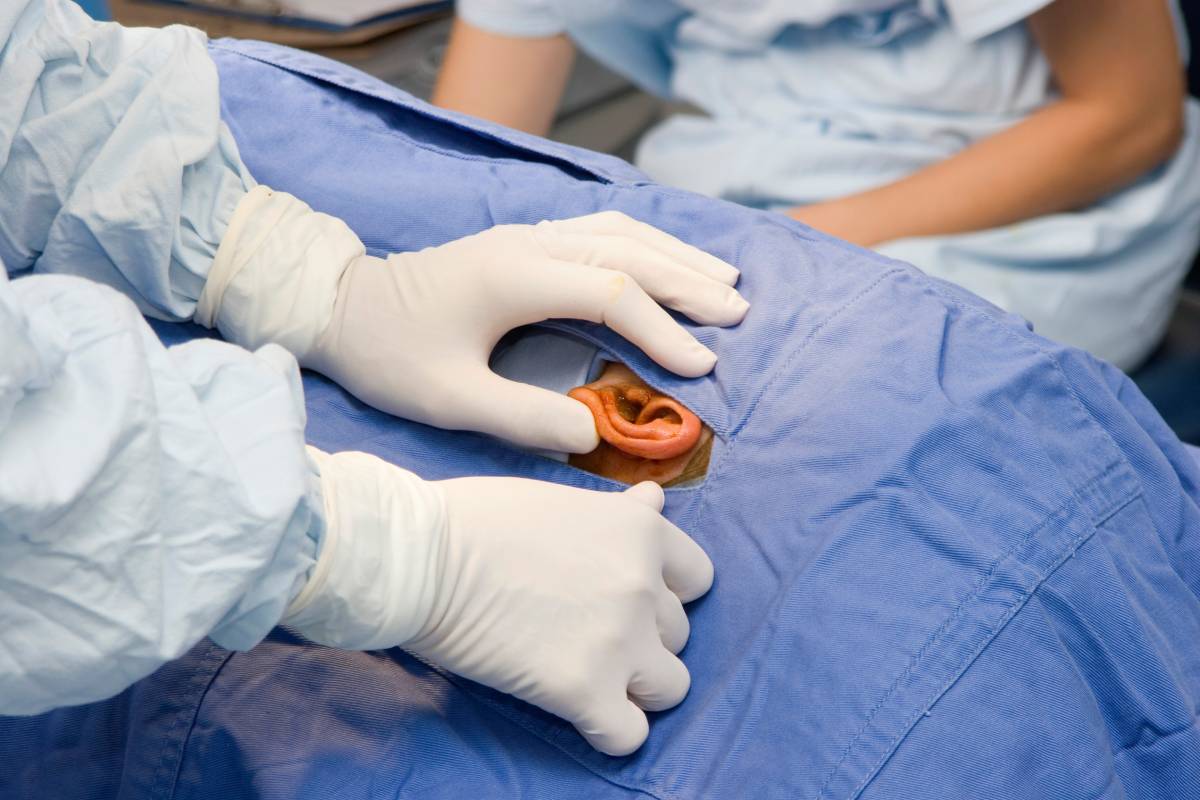 Cochlear Implant Surgery in Outpatient Settings