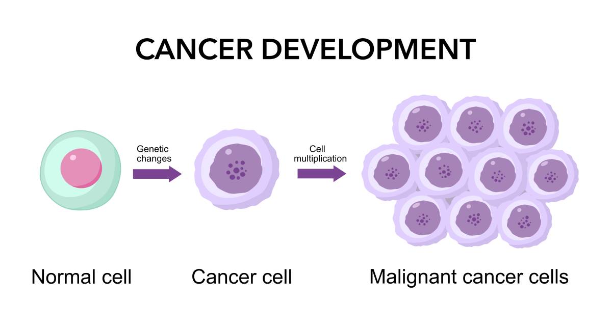 Lidocaine in Cancer Progression